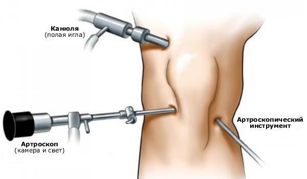 Artroskopija kolenskega sklepa