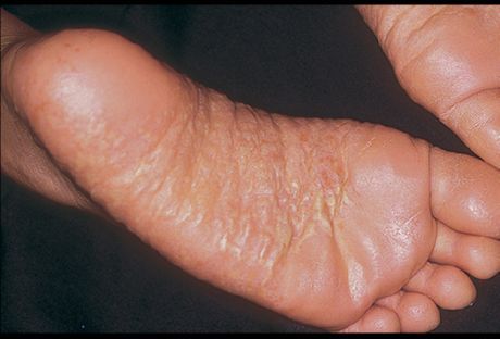 Dermatitis nog in njenih vzrokov