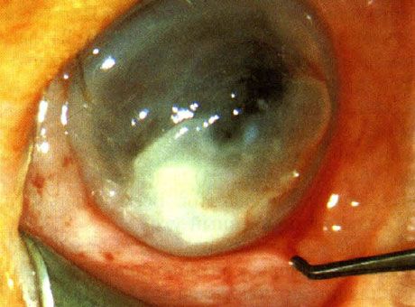 Keratitis, ki ga povzročijo Pseudomonas pri novorojenčku.  Faktorji predispozicije niso opredeljeni