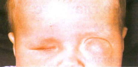 Mikrofaltom s sočasno nastajanjem ciste (levo oko).  Anoftalmus (desno oko).