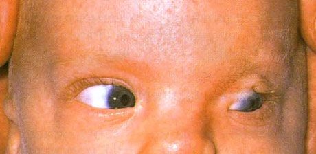 Fraserjev sindrom.  Nepopolni kriptoftalmi levega očesa.