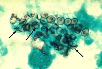 Vzročni dejavnik pneumociste (Pneumocystis jiroveci)