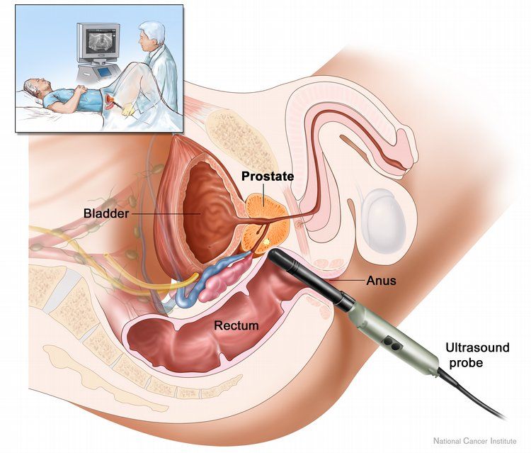 Učinkovito zdravilo proti raku prostate, ki temelji na čaju in zlatu, je bilo ustvarjeno