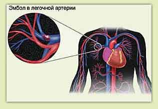 Pulmonarna embolija in bolečine v prsnem košu na levi strani