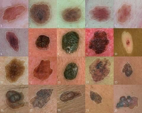 Znanstveniki so našli gen, ki ima osrednjo vlogo pri razvoju melanoma