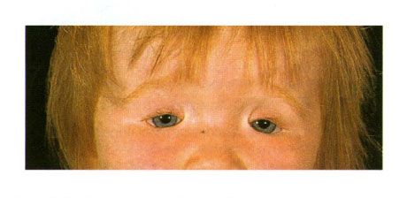 Dvostranski kolobom vek v otroku z Goldenovim sindromom.  Zapiranje reže na levi